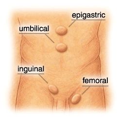 Types of Hernia